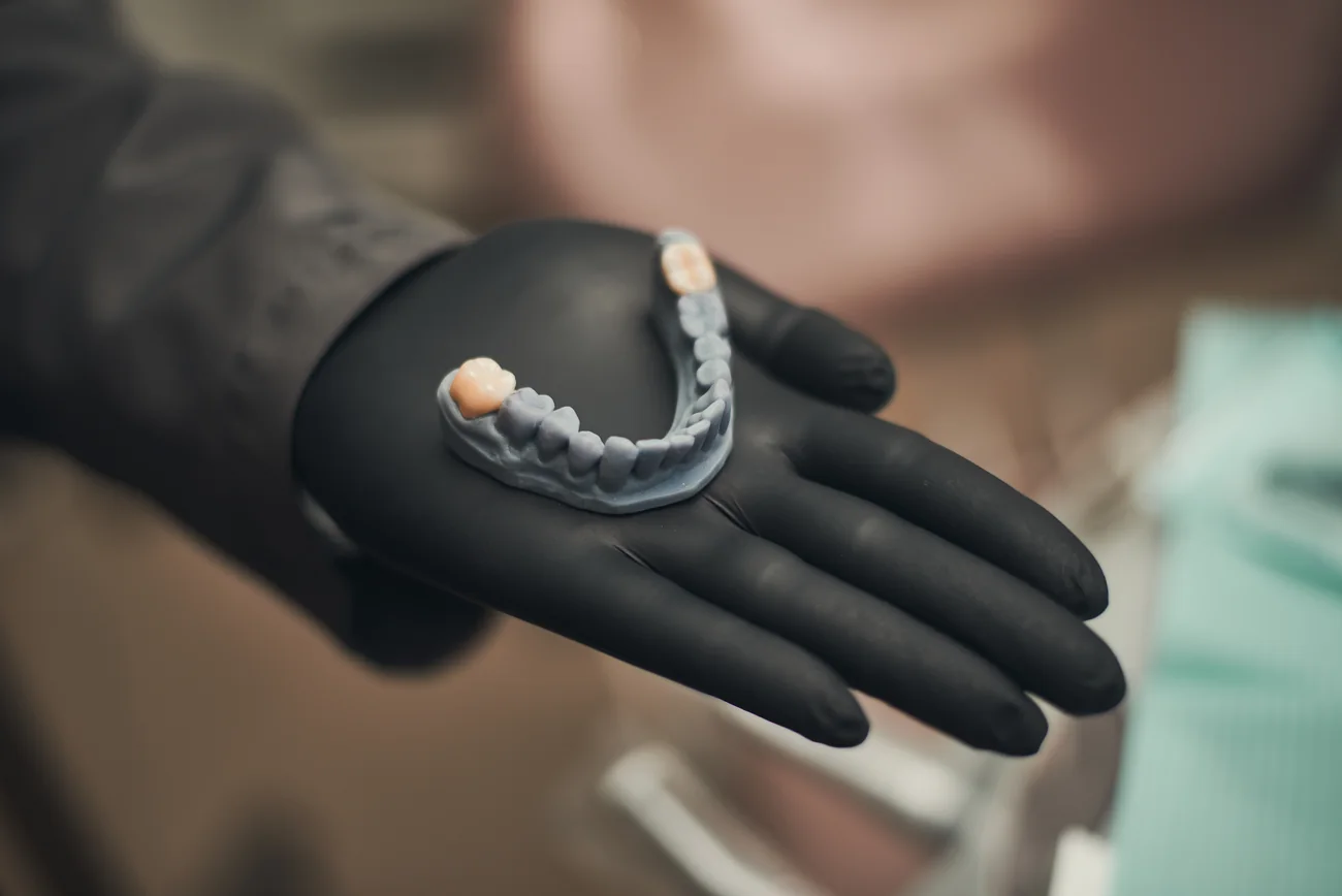 Modelo odontológico para planejamento restaurador, com coroas, segurado com luva.